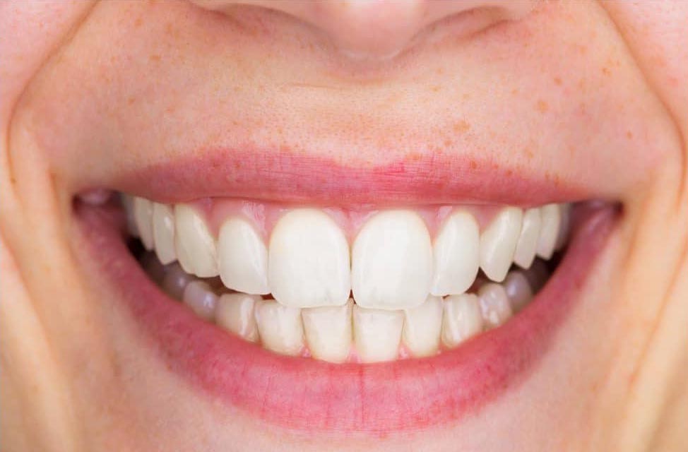 wybielanie zębów kraków