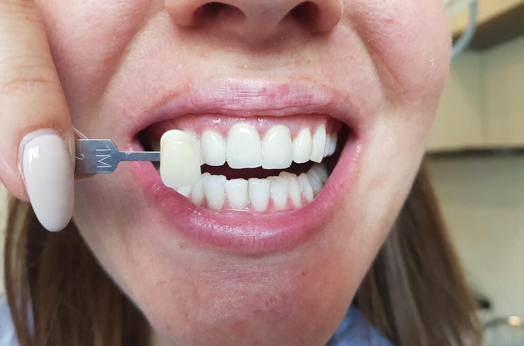 Wybielanie zębów – poznaj metody i efekty. Która opcja jest dla Ciebie?
