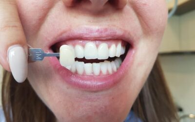 Wybielanie zębów – poznaj metody i efekty. Która opcja jest dla Ciebie?
